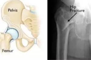 Hip Fracture Caused By Slip and Fall Accident