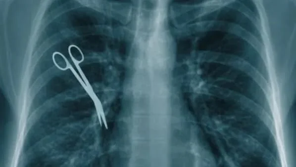 Chest X-ray showing surgical scissors left inside a patient's body after an operation — surgical error lawyer NYC